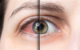 Oculoplasty in Kharadi, Pune
